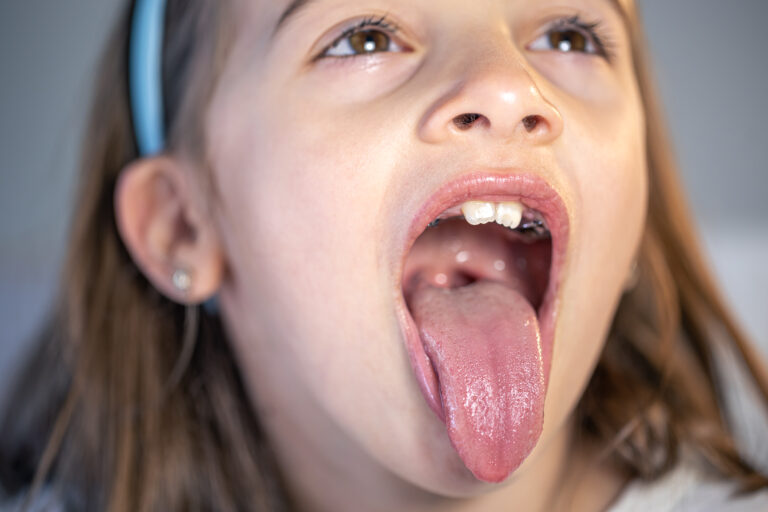 Tonsillitis in children