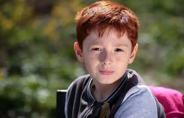 Juvenile Dermatomyositis (JDM) Juvenile Dermatomyositis (JDM)